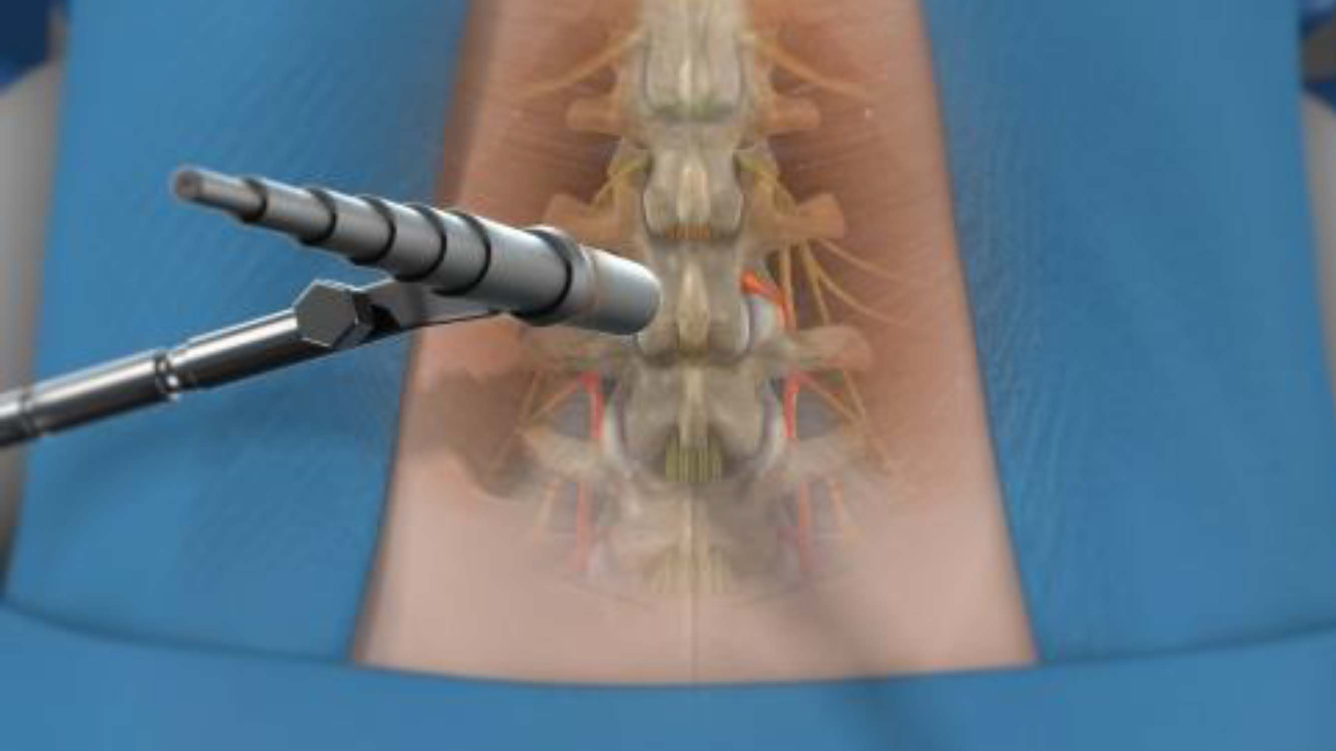 脊椎AI微創手術