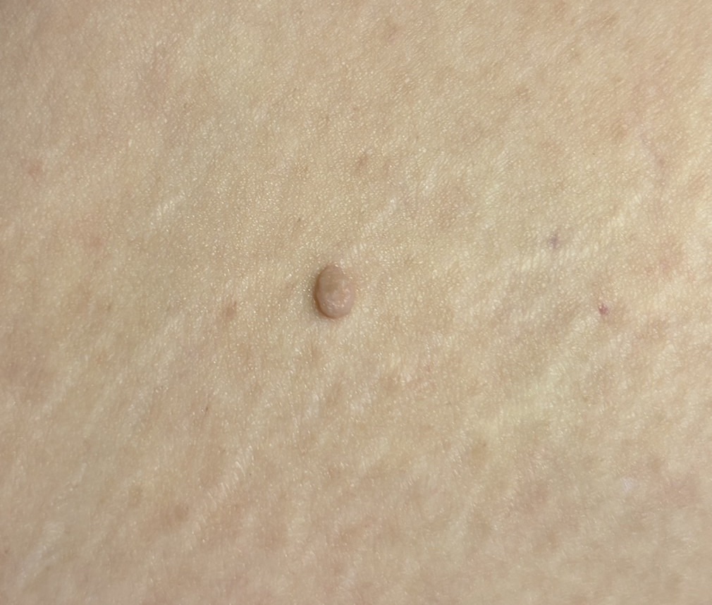 雖是良性皮膚增生：贅生皮也可能出現紅腫發炎